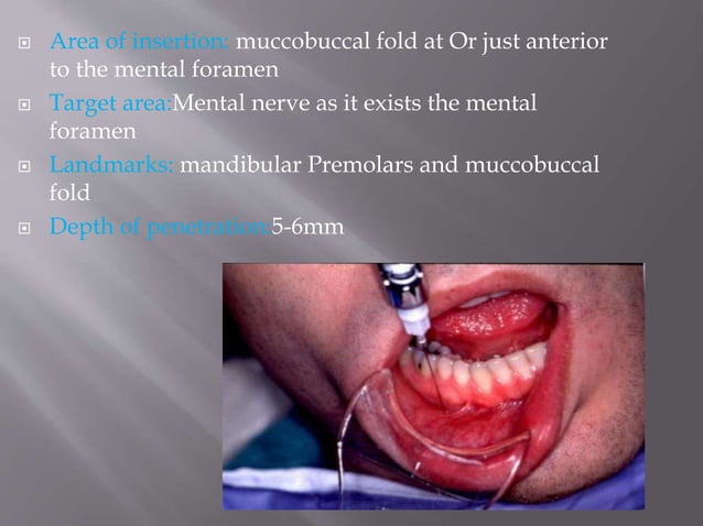 Mandibular injection techniques | PPT