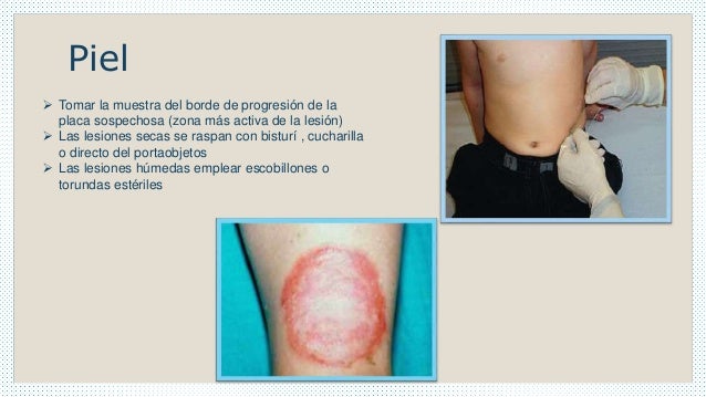 Toma de-muestra-dermatofitos Toma de-muestra-dermatofitos