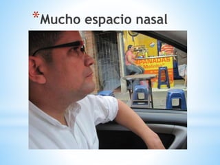 *Mucho espacio nasal
 