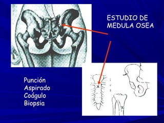ESTUDIO DE
MEDULA OSEA
Punción
Aspirado
Coágulo
Biopsia
 