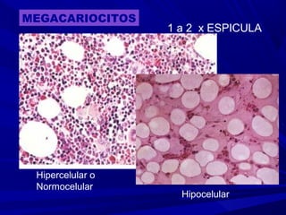MEGACARIOCITOS
1 a 2 x ESPICULA
Hipercelular o
Normocelular
Hipocelular
 