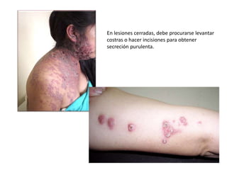 En lesiones cerradas, debe procurarse levantar
costras o hacer incisiones para obtener
secreción purulenta.
 