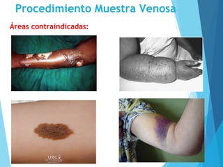 Procedimiento Muestra Venosa
Áreas contraindicadas:
 