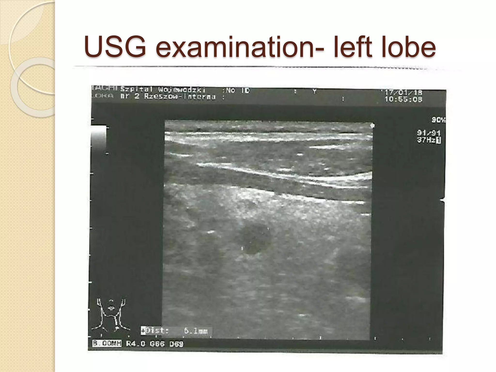 USG examination- left lobe
 