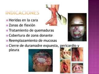  Heridas en la cara
 Zonas de flexión
 Tratamiento de quemaduras
 Cobertura de zona donante
 Reemplazamiento de mucosas
 Cierre de duramadre expuesta, pericardio y
  pleura
 