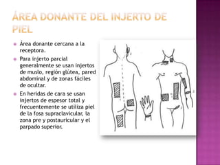    Área donante cercana a la
    receptora.
   Para injerto parcial
    generalmente se usan injertos
    de muslo, región glútea, pared
    abdominal y de zonas fáciles
    de ocultar.
   En heridas de cara se usan
    injertos de espesor total y
    frecuentemente se utiliza piel
    de la fosa supraclavicular, la
    zona pre y postauricular y el
    parpado superior.
 