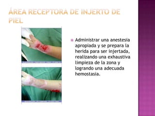    Administrar una anestesia
    apropiada y se prepara la
    herida para ser injertada,
    realizando una exhaustiva
    limpieza de la zona y
    logrando una adecuada
    hemostasia.
 