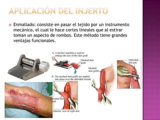    Enmallado: consiste en pasar el tejido por un instrumento
    mecánico, el cual le hace cortes lineales que al estirar
    toman un aspecto de rombos. Este método tiene grandes
    ventajas funcionales.
 
