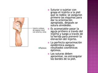    Suturar o sujetar con
    grapa el injerto a la piel
    que lo rodea; se aseguran
    primero las esquinas para
    dar la orientación
    apropiada, después se
    sutura alrededor.
   Es aconsejable pasar la
    aguja primero a través del
    injerto y luego a través de
    la herida para prevenir la
    elevación del injerto.
   La perfecta aproximación
    epidérmica asegura
    resultados cosméticos
    óptimos.
   Las suturas deben
    aproximar, no estrangular
    los bordes de la piel.
 
