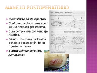  Inmovilización de injertos:
 Capitoneo: colocar gasas con
  sutura anudada por encima.
 Cura compresiva con vendaje
  elástico.
 Férulas: En zonas de flexión
  donde la contracción de los
  injertos es mayor
 Evacuación de seromas/

  hematomas
 