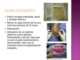    Cubrir con gasa engrasada, gasas
    y vendaje elástico.
   Retirar la capa externa de la cura
    entre las primeras 24-72 horas.
   Hidratación.
   Utilización de un material
    adhesivo (como apósitos
    hidrocoloides y de otro tipo) que
    se une a la piel manteniendo la
    zona húmeda. Esta cura se
    mantiene hasta la reepitelización
    completa.
 