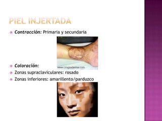    Contracción: Primaria y secundaria




   Coloración:
   Zonas supraclaviculares: rosado
   Zonas inferiores: amarillento/parduzco
 