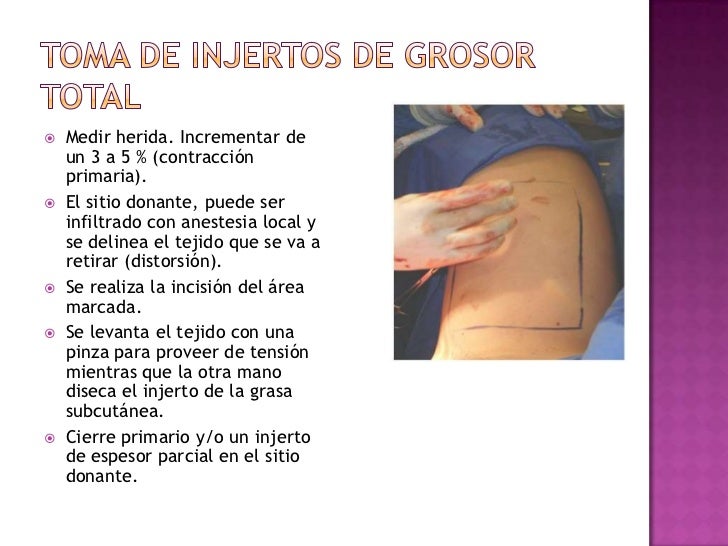 Toma y aplicación de injertos