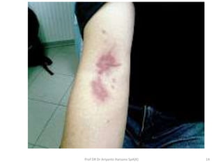 Tomcat Insect Rash Tomcat stings | PPTX