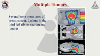 Multiple Tumors
Several bone metastases of
breast cancer. Lesions in the
third left rib, os sacrum and
lumbar
 