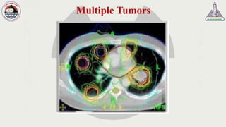 Multiple Tumors
 
