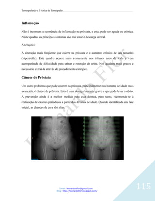 Tomografando a Técnica de Tomografar_______________________________________________________




Inflamação

Não é incomum a ocorrência de inflamação na próstata, e esta, pode ser aguda ou crônica.
Neste quadro, os principais sintomas são mal estar e descarga uretral.

Alterações:

A alteração mais freqüente que ocorre na próstata é o aumento crônico de seu tamanho
(hipertrofia). Este quadro ocorre mais comumente nos últimos anos de vida e vem
acompanhada de dificuldade para urinar e retenção de urina. Nos quadros mais graves é
necessário extraí-la através de procedimento cirúrgico.

Câncer de Próstata

Um outro problema que pode ocorrer na próstata, principalmente nos homens de idade mais
avançada, é câncer de próstata. Esta é uma doença bastante grave e que pode levar a óbito.
A prevenção ainda é a melhor medida para esta doença, para tanto, recomenda-se à
realização de exames periódicos a partir dos 40 anos de idade. Quando identificada em fase
inicial, as chances de cura são altas.




                                 Email: leonardosflor@gmail.com
                              Blog: http://leonardoflor.blogspot.com/
                                                                                              115
 