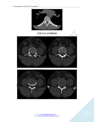 Tomografando a Técnica de Tomografar_______________________________________________________




                                COLUNA LOMBAR




                               Email: leonardosflor@gmail.com
                            Blog: http://leonardoflor.blogspot.com/
                                                                                              131
 