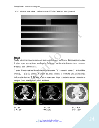 Tomografando a Técnica de Tomografar_______________________________________________________

OBS: Conforme a escala de cinza diremos Hipodenso, Isodenso ou Hiperdenso.




Janela
Janelas são recursos computacionais que permitem após a obtenção das imagens as escala
de cinza possa ser estreitada ou alargada, facilitando a diferenciação entre certas estruturas
de acordo com a necessidade.
A janela é composta por dois elementos: o contraste (W – width ou largura) e a densidade
óptica (L – level ou centro). A largura da janela controla o contraste: uma janela ampla
indica mais números de TC que refletem uma escala longa e, portanto, menos contraste na
imagem, como o exemplo da janela pulmonar.




WC: 55                                 WC: 95                               WC: - 650
WW: 350                                WW: 350                              WW: 1200




                                Email: leonardosflor@gmail.com
                             Blog: http://leonardoflor.blogspot.com/
                                                                                                 14
 