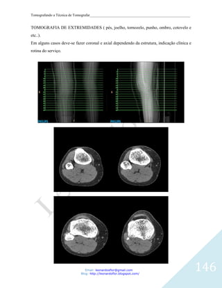 Tomografando a Técnica de Tomografar_______________________________________________________


TOMOGRAFIA DE EXTREMIDADES ( pés, joelho, tornozelo, punho, ombro, cotovelo e
etc..).
Em alguns casos deve-se fazer coronal e axial dependendo da estrutura, indicação clínica e
rotina do serviço.




                               Email: leonardosflor@gmail.com
                            Blog: http://leonardoflor.blogspot.com/
                                                                                              146
 