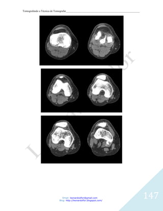 Tomografando a Técnica de Tomografar_______________________________________________________




                               Email: leonardosflor@gmail.com
                            Blog: http://leonardoflor.blogspot.com/
                                                                                              147
 