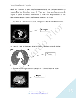 Tomografando a Técnica de Tomografar_______________________________________________________


Outro fator é o centro da janela, também denominado nível, que controla a densidade da
imagem. Esse valor determina o número de TC que será o cinza central e os extremos da
largura da janela. Escolhe-se, normalmente, o tecido mais freqüentemente de uma
determinada pela maior estrutura anatômica que se encontra em estudo.

EX: No exame de Tórax mediastino devera corresponder a densidade média do coração.




                                                      Coração




No exame de Tórax parênquima devera corresponder a densidade media do pulmão.




                                                                Pulmão




No exame de abdome superior devera corresponder a densidade média do fígado.



                                            Fígado




                               Email: leonardosflor@gmail.com
                            Blog: http://leonardoflor.blogspot.com/
                                                                                              15
 