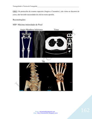 Tomografando a Técnica de Tomografar_______________________________________________________


OBS3: Os protocolos de exames especiais (Angios e Coronária ), são vistos no decorrer do
curso, não havendo necessidade de citá-los nesta apostila.

Reconstruções:

MIP- Máxima intensidade de Pixel

          Angio Membros Inferiores                           Tórax




                                          3D




                                Email: leonardosflor@gmail.com
                             Blog: http://leonardoflor.blogspot.com/
                                                                                              162
 
