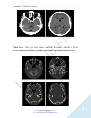 Tomografando a Técnica de Tomografar_______________________________________________________




Filtros duros - filtro com maior nitidez e definição da imagem realçando as bordas,
margens ou estrutura anatômica, utilizado para estruturas com grande densidade (osso).




                               Email: leonardosflor@gmail.com
                            Blog: http://leonardoflor.blogspot.com/
                                                                                              26
 