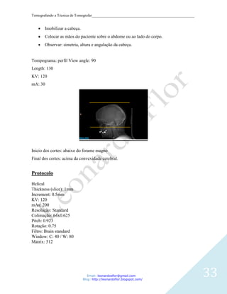 Tomografando a Técnica de Tomografar_______________________________________________________


       Imobilizar a cabeça.
       Colocar as mãos do paciente sobre o abdome ou ao lado do corpo.
       Observar: simetria, altura e angulação da cabeça.


Tompograma: perfil View angle: 90
Length: 130
KV: 120
mA: 30




Inicio dos cortes: abaixo do forame magno
Final dos cortes: acima da convexidade cerebral.


Protocolo

Helical
Thickness (slice): 1mm
Increment: 0.5mm
KV: 120
mAs: 200
Resolução: Standard
Colimação: 64x0.625
Pitch: 0.923
Rotação: 0.75
Filtro: Brain standard
Window: C: 40 / W: 80
Matrix: 512




                                 Email: leonardosflor@gmail.com
                              Blog: http://leonardoflor.blogspot.com/
                                                                                              33
 