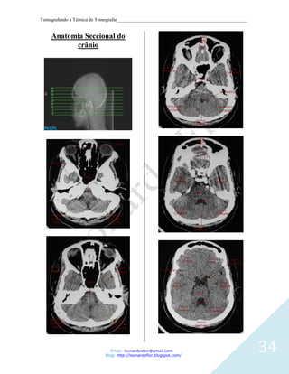 Tomografando a Técnica de Tomografar_______________________________________________________


    Anatomia Seccional do
          crânio




                               Email: leonardosflor@gmail.com
                            Blog: http://leonardoflor.blogspot.com/
                                                                                              34
 