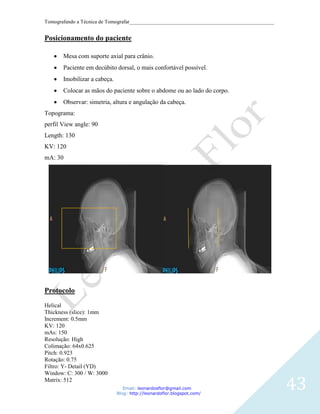 Tomografando a Técnica de Tomografar_______________________________________________________


Posicionamento do paciente

       Mesa com suporte axial para crânio.
       Paciente em decúbito dorsal, o mais confortável possível.
       Imobilizar a cabeça.
       Colocar as mãos do paciente sobre o abdome ou ao lado do corpo.
       Observar: simetria, altura e angulação da cabeça.
Topograma:
perfil View angle: 90
Length: 130
KV: 120
mA: 30




Protocolo
Helical
Thickness (slice): 1mm
Increment: 0.5mm
KV: 120
mAs: 150
Resolução: High
Colimação: 64x0.625
Pitch: 0.923
Rotação: 0.75
Filtro: Y- Detail (YD)
Window: C: 300 / W: 3000
Matrix: 512
                                 Email: leonardosflor@gmail.com
                              Blog: http://leonardoflor.blogspot.com/
                                                                                              43
 