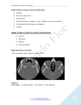 Tomografando a Técnica de Tomografar_______________________________________________________


INDICAÇÕES CLÍNICAS (SEM CONTRASTE)
    Sinusite;
    Desvio de septo nasal;
    Má formação;
    Osteomas (tumores benignos mais freqüentes dos seios paranasais);
    Encondroma (tumor benigno de cartilagem).
    Fraturas


INDICAÇÕES CLÍNICAS (COM CONTRASTE)
           Tumores.
           Metástases.
           Polipose.
           Cisto de retenção.


PREPARO PARA O EXAME
 Não é necessário, apenas realizar a higiene nasal.




Imagem 1
Corte axial. 1, Cavidade orbitária. 2, Seio frontal. 3, Osso esfenóide




                                Email: leonardosflor@gmail.com
                             Blog: http://leonardoflor.blogspot.com/
                                                                                              44
 