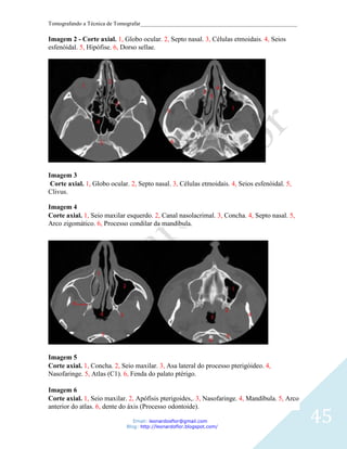 Tomografando a Técnica de Tomografar_______________________________________________________

Imagem 2 - Corte axial. 1, Globo ocular. 2, Septo nasal. 3, Células etmoidais. 4, Seios
esfenóidal. 5, Hipófise. 6, Dorso sellae.




Imagem 3
 Corte axial. 1, Globo ocular. 2, Septo nasal. 3, Células etmoidais. 4, Seios esfenóidal. 5,
Clivus.

Imagem 4
Corte axial. 1, Seio maxilar esquerdo. 2, Canal nasolacrimal. 3, Concha. 4, Septo nasal. 5,
Arco zigomático. 6, Processo condilar da mandíbula.




Imagem 5
Corte axial. 1, Concha. 2, Seio maxilar. 3, Asa lateral do processo pterigóideo. 4,
Nasofaringe. 5, Atlas (C1). 6, Fenda do palato ptérigo.

Imagem 6
Corte axial. 1, Seio maxilar. 2, Apófisis pterigoides,. 3, Nasofaringe. 4, Mandíbula. 5, Arco


                                                                                                45
anterior do atlas. 6, dente do áxis (Processo odontoide).

                                Email: leonardosflor@gmail.com
                             Blog: http://leonardoflor.blogspot.com/
 