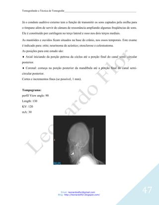 Tomografando a Técnica de Tomografar_______________________________________________________



Já o conduto auditivo externo tem a função de transmitir os sons captados pela orelha para
o tímpano além de servir de câmara de ressonância ampliando algumas freqüências de sons.
Ele é constituído por cartilagem no terço lateral e osso nos dois terços mediais.

As mastóides e ouvidos ficam situados na base do crânio, nos ossos temporais. Este exame
é indicado para: otite; neurinoma de acústico; otosclerose e colesteatoma.
As posições para este estudo são:
   Axial iniciando da porção petrosa da cóclea até a porção final do canal semi- circular
posterior.
   Coronal: começa na porção posterior da mandíbula até a porção final do canal semi-
circular posterior.
Cortes e incrementos finos (se possível, 1 mm).


Tompograma:
perfil View angle: 90
Length: 130
KV: 120
mA: 30




                                Email: leonardosflor@gmail.com
                             Blog: http://leonardoflor.blogspot.com/
                                                                                              47
 