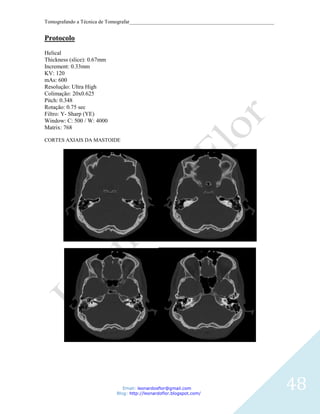 Tomografando a Técnica de Tomografar_______________________________________________________


Protocolo
Helical
Thickness (slice): 0.67mm
Increment: 0.33mm
KV: 120
mAs: 600
Resolução: Ultra High
Colimação: 20x0.625
Pitch: 0.348
Rotação: 0.75 sec
Filtro: Y- Sharp (YE)
Window: C: 500 / W: 4000
Matrix: 768

CORTES AXIAIS DA MASTOIDE




                               Email: leonardosflor@gmail.com
                            Blog: http://leonardoflor.blogspot.com/
                                                                                              48
 
