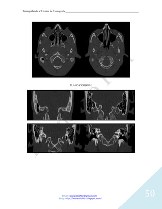 Tomografando a Técnica de Tomografar_______________________________________________________




                                     PLANO CORONAL




                               Email: leonardosflor@gmail.com
                            Blog: http://leonardoflor.blogspot.com/
                                                                                              50
 