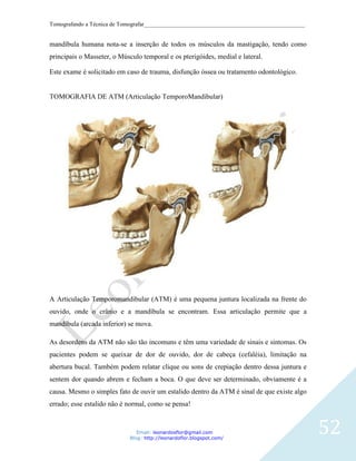 Tomografando a Técnica de Tomografar_______________________________________________________


mandíbula humana nota-se a inserção de todos os músculos da mastigação, tendo como
principais o Masseter, o Músculo temporal e os pterigóides, medial e lateral.

Este exame é solicitado em caso de trauma, disfunção óssea ou tratamento odontológico.


TOMOGRAFIA DE ATM (Articulação TemporoMandibular)




A Articulação Temporomandibular (ATM) é uma pequena juntura localizada na frente do
ouvido, onde o crânio e a mandíbula se encontram. Essa articulação permite que a
mandíbula (arcada inferior) se mova.

As desordens da ATM não são tão incomuns e têm uma variedade de sinais e sintomas. Os
pacientes podem se queixar de dor de ouvido, dor de cabeça (cefaléia), limitação na
abertura bucal. Também podem relatar clique ou sons de crepiação dentro dessa juntura e
sentem dor quando abrem e fecham a boca. O que deve ser determinado, obviamente é a
causa. Mesmo o simples fato de ouvir um estalido dentro da ATM é sinal de que existe algo
errado; esse estalido não é normal, como se pensa!



                                Email: leonardosflor@gmail.com
                             Blog: http://leonardoflor.blogspot.com/
                                                                                              52
 