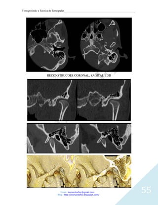 Tomografando a Técnica de Tomografar_______________________________________________________




                    RECONSTRUCOES CORONAL, SAGITAL E 3D




                               Email: leonardosflor@gmail.com
                            Blog: http://leonardoflor.blogspot.com/
                                                                                              55
 