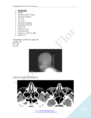 Tomografando a Técnica de Tomografar_______________________________________________________


       Protocolo
       Helical
       Thickness (slice): 0.9mm
       Increment: 0.45mm
       KV: 120
       mAs: 150
       Resolução: Standard
       Colimação: 64x0.625
       Pitch: 0.64
       Rotação: 0.5 sec
       Filtro: Bone (D)
       Window: C: 300 / W: 3000
       Matrix: 512

Tompograma: perfil View angle: 90
Length: 130
KV: 120
mA: 30




CORTES AXIAIS DAS ORBITAS




                               Email: leonardosflor@gmail.com
                            Blog: http://leonardoflor.blogspot.com/
                                                                                              58
 