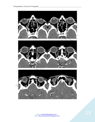 Tomografando a Técnica de Tomografar_______________________________________________________




                               Email: leonardosflor@gmail.com
                            Blog: http://leonardoflor.blogspot.com/
                                                                                              59
 