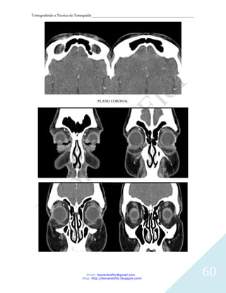 Tomografando a Técnica de Tomografar_______________________________________________________




                                     PLANO CORONAL




                               Email: leonardosflor@gmail.com
                            Blog: http://leonardoflor.blogspot.com/
                                                                                              60
 