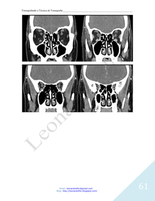 Tomografando a Técnica de Tomografar_______________________________________________________




                               Email: leonardosflor@gmail.com
                            Blog: http://leonardoflor.blogspot.com/
                                                                                              61
 