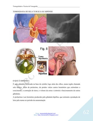 Tomografando a Técnica de Tomografar_______________________________________________________


TOMOGRAFIA DE SELA TURCICA OU HIPÓFISE




O QUE É HIPÓFISE?
É uma glândula localizada na base do cérebro logo atrás dos olhos, numa região chamada
sela túrcica. Além da prolactina, ela produz vários outros hormônios que estimulam o
crescimento, a contração do útero, o volume da urina e controla o funcionamento de outras
glândulas.
A prolactina é um hormônio produzido pela glândula hipófise, que estimula a produção de
leite pela mama no período da amamentação




                               Email: leonardosflor@gmail.com
                            Blog: http://leonardoflor.blogspot.com/
                                                                                              62
 