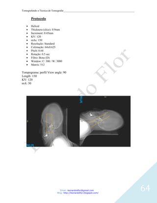 Tomografando a Técnica de Tomografar_______________________________________________________


       Protocolo

       Helical
       Thickness (slice): 0.9mm
       Increment: 0.45mm
       KV: 120
       mAs: 150
       Resolução: Standard
       Colimação: 64x0.625
       Pitch: 0.64
       Rotação: 0.5 sec
       Filtro: Bone (D)
       Window: C: 300 / W: 3000
       Matrix: 512

Tompograma: perfil View angle: 90
Length: 130
KV: 120
mA: 30




                               Email: leonardosflor@gmail.com
                            Blog: http://leonardoflor.blogspot.com/
                                                                                              64
 