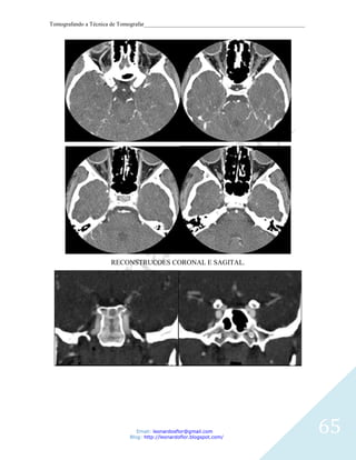 Tomografando a Técnica de Tomografar_______________________________________________________




                     RECONSTRUCOES CORONAL E SAGITAL.




                               Email: leonardosflor@gmail.com
                            Blog: http://leonardoflor.blogspot.com/
                                                                                              65
 