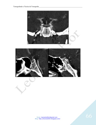 Tomografando a Técnica de Tomografar_______________________________________________________




                               Email: leonardosflor@gmail.com
                            Blog: http://leonardoflor.blogspot.com/
                                                                                              66
 