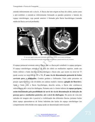 Tomografando a Técnica de Tomografar_______________________________________________________


estende inferiormente até o cóccix. A fáscia alar tem origem na base do crânio, assim como
a pré-vertebral, e estende-se inferiormente formando as paredes posterior e laterais do
espaço retrofaríngeo, cuja parede anterior é formada pela fáscia bucofaríngea (camada
média da fáscia cervical profunda).




               TC em corte sagital evidenciando tumoração expansiva em cavum, com invasão retrofaríngea.
          TC em corte axial evidenciando destruição óssea,invasão retrocraniana e parede lateral do seio cavernoso.



O espaço potencial existente entre a fáscia alar e a fáscia pré-vertebral é o espaço perigoso.
O espaço retrofaríngeo estende-se da base do crânio ao mediastino superior, sendo seu
limite inferior a fusão das fáscias bucofaríngea e fáscia alar, que ocorre no nível de T3
(pode ocorrer no intervalo de C6 a T6). É uma via de disseminação potencial de lesões
cervicais para o mediastino. Contém gordura e linfonodos. Estes estão presentes na
porção supra-hióidea e são divididos em cadeias medial e laterais (gânglio de Rouvière).
Após a fusão com a fáscia bucofaríngea, descrita acima, a fáscia alar continua-se
inferiormente até o nível do diafragma. Portanto este é o limite inferior do espaço perigoso,
assim denominado pela possibilidade de servir de via de disseminação de infecções do
pescoço para o mediastino posterior, até o nível do diafragma. Do ponto de vista dos
métodos de imagem não é possível a visibilização das diferentes fáscias, portanto lesões
deste espaço apresentam-se de forma indistinta das lesões do espaço retrofaríngeo (no
compartimento infra-hióide este espaço pode ser denominado retrovisceral).




                                        Email: leonardosflor@gmail.com
                                     Blog: http://leonardoflor.blogspot.com/
                                                                                                                      73
 