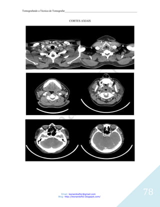 Tomografando a Técnica de Tomografar_______________________________________________________


                                      CORTES AXIAIS




                               Email: leonardosflor@gmail.com
                            Blog: http://leonardoflor.blogspot.com/
                                                                                              78
 