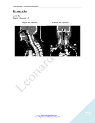 Tomografando a Técnica de Tomografar_______________________________________________________


Reconstruções

Axial 2/2
Sagital e Coronal 3/3

           Sagital pós contraste                       Coronal pós contraste




                               Email: leonardosflor@gmail.com
                            Blog: http://leonardoflor.blogspot.com/
                                                                                              79
 