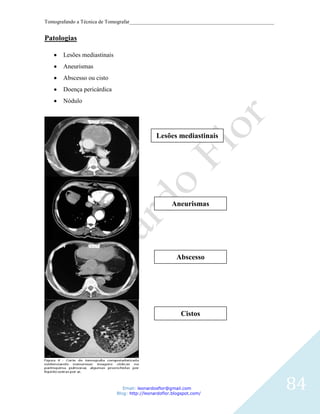 Tomografando a Técnica de Tomografar_______________________________________________________


Patologias

       Lesões mediastinais
       Aneurismas
       Abscesso ou cisto
       Doença pericárdica
       Nódulo




                                               Lesões mediastinais




                                                      Aneurismas




                                                        Abscesso




                                                          Cistos




                                Email: leonardosflor@gmail.com
                             Blog: http://leonardoflor.blogspot.com/
                                                                                              84
 